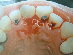歯周病の原因5