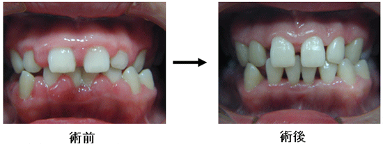 歯周病の治療9