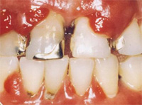 歯周病の進行6