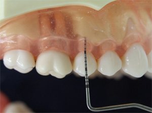 歯周組織精密検査