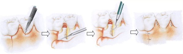 歯周病の治療3
