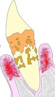 歯周病の進行7