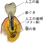 インプラント2