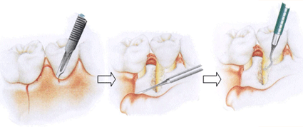 歯周病の治療5