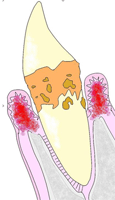 歯周病の進行5