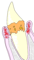 歯周病の進行3
