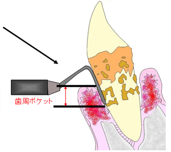 歯周病の治療2