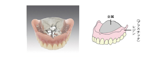 入れ歯6